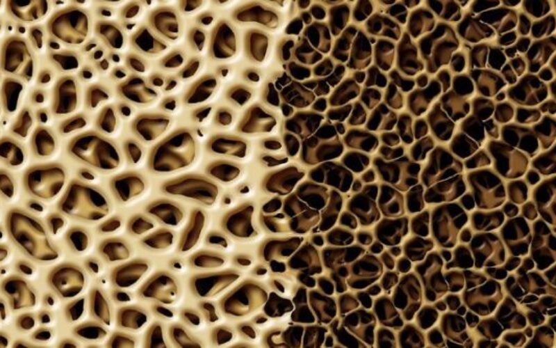 Osteoporosi, 4,5 milioni di casi in Italia